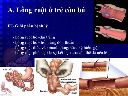 Lồng ruột ở trẻ em: Dễ nhầm với rối loạn tiêu hóa