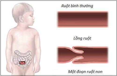 Lồng ruột ở trẻ em là bệnh gì?