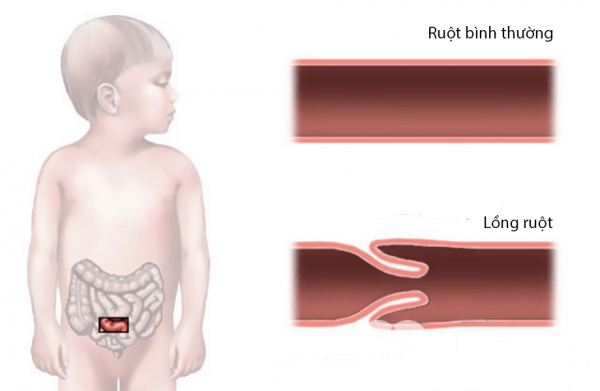 Lồng ruột ở trẻ em là gì? cần điều trị như thế nào