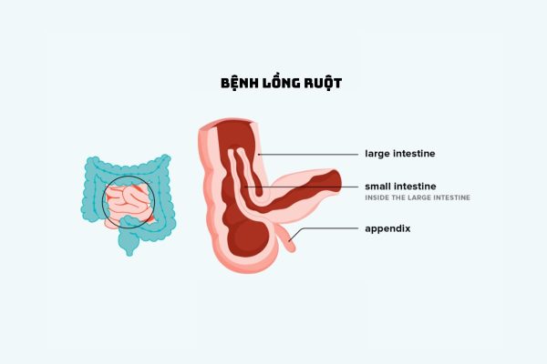 Lồng ruột ở trẻ em: Nguyên nhân, triệu chứng, cách xử trí