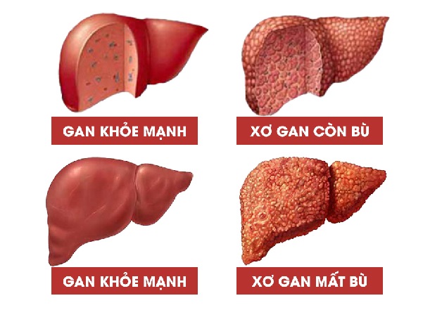 Lựa chọn 8 loại hoa quả tốt cho người xơ gan