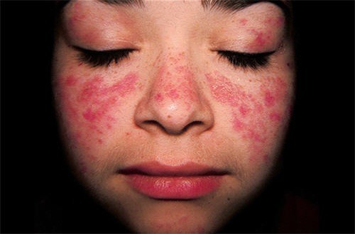 Lupus ban đỏ hệ thống nguy hiểm như thế nào?