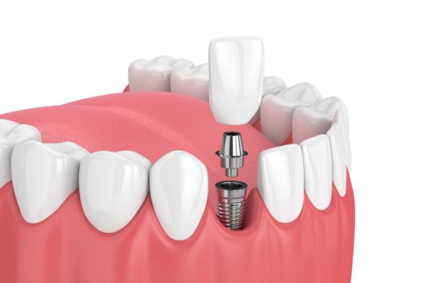 Lưu ý chăm sóc răng sau khi cắm Implant đúng cách