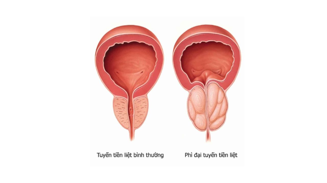 Lưu ý khi dùng thuốc đặc trị phì đại tiền liệt tuyến