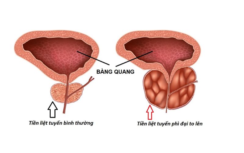 Lưu ý khi dùng thuốc đặc trị phì đại tiền liệt tuyến