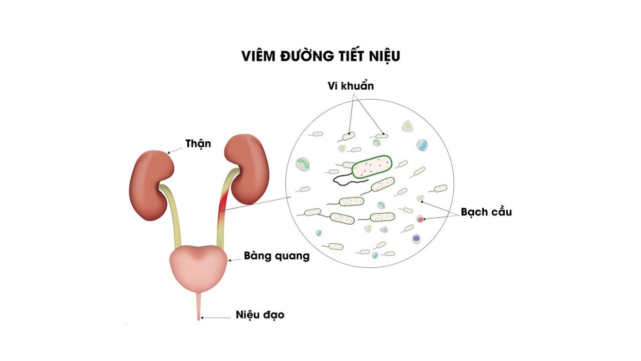 Lưu ý khi dùng thuốc Midasol điều trị một số bệnh lý tiết niệu