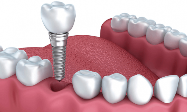 Lưu ý sau khi cấy ghép implant để nhanh hồi phục