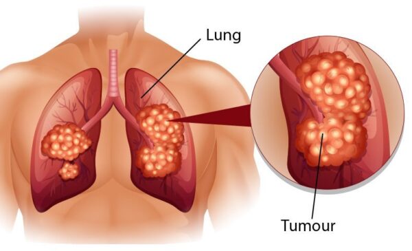 Lưu ý về chụp CT trong khám tầm soát ung thư phổi