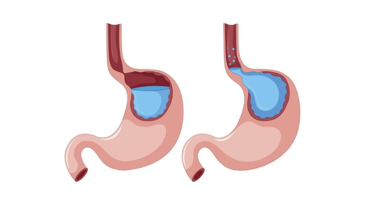 Lý do trào ngược dạ dày – thực quản, chẩn đoán và điều trị