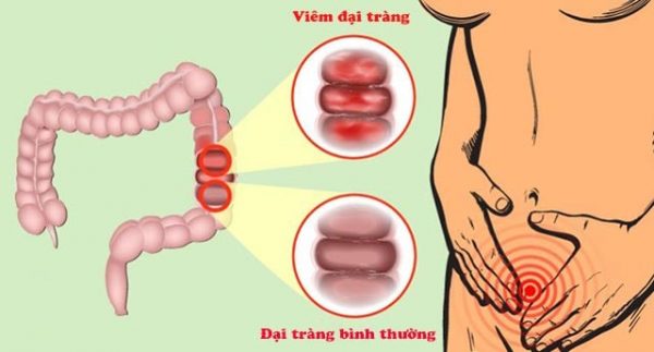 Lý giải 3 nguyên nhân đau đại tràng khiến nhiều người