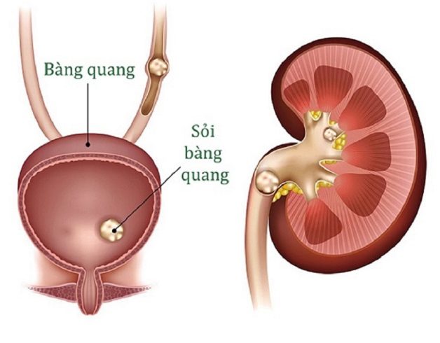 soi bang quang 5mm e1667552279436