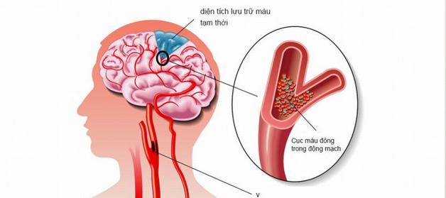 Lý giải nguyên nhân tại sao thiếu máu não xảy ra?