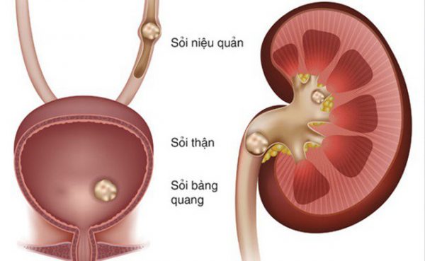 Lý giải những sai lầm trong cách điều trị sỏi thận