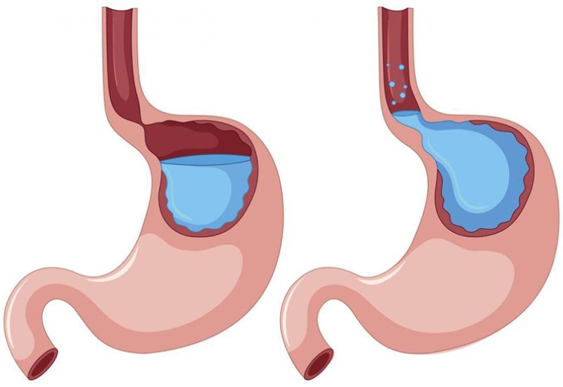 Lý giải trào ngược dạ dày gây đau rát ngực