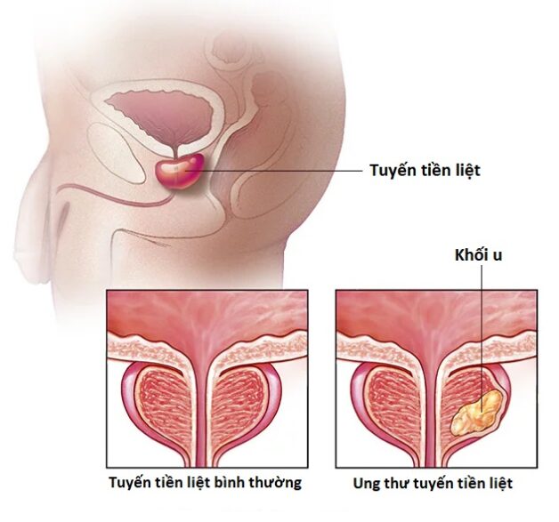 Lý giải ung thư tuyến tiền liệt sống được bao lâu