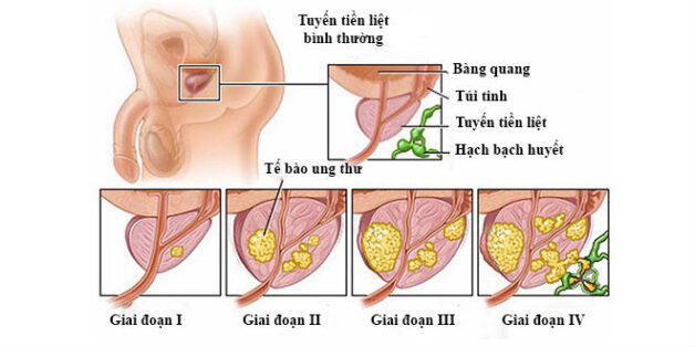 Lý giải ung thư tuyến tiền liệt sống được bao lâu