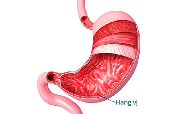 Mắc bệnh loét hang vị dạ dày có nguy hiểm không?