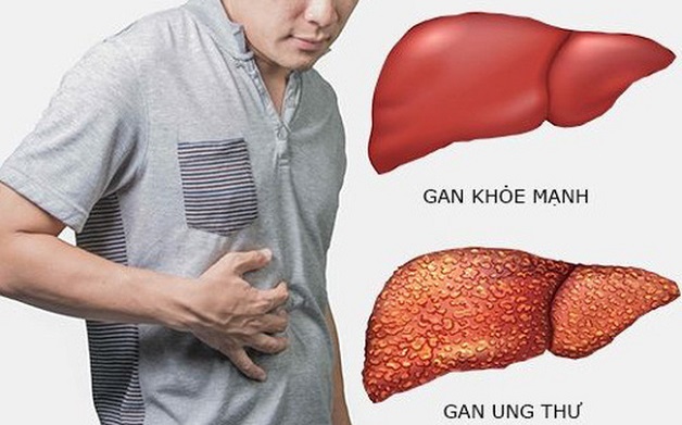  Mắc bệnh viêm gan B có chữa trị được không?