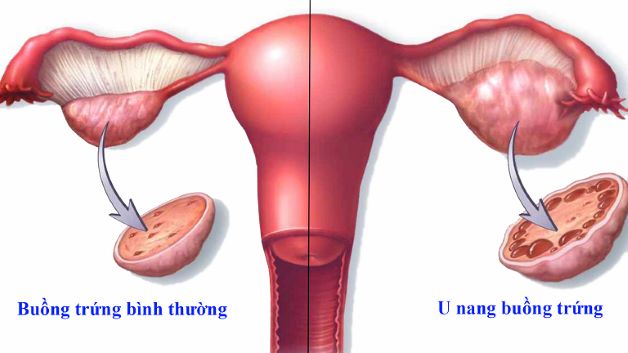 Mắc u nang buồng trứng trái có mang thai được không?