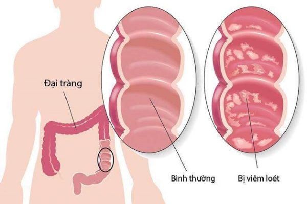 Mắc viêm đại tràng nên ăn gì để thuyên giảm triệu chứng?