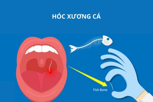 Mắc xương cá ở họng cần được xử trí kịp thời, đúng cách