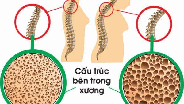 Mách bạn các biện pháp phòng ngừa loãng xương