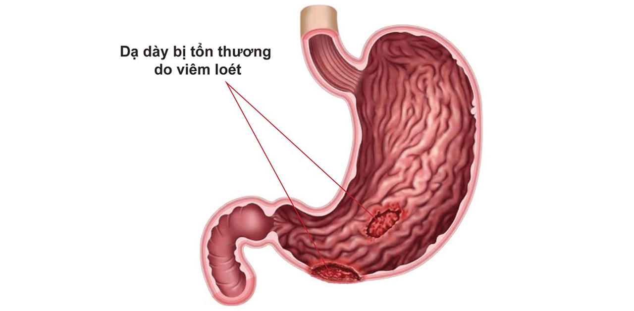 Mách bạn các cách trị loét bao tử hiệu quả 