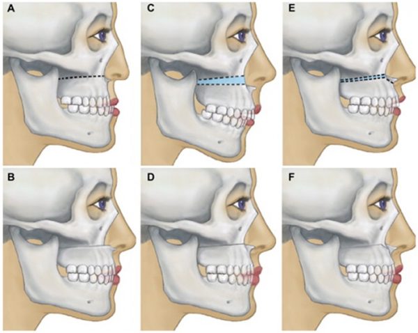 Mách bạn chi phí phẫu thuật hàm hô mới nhất hiện nay