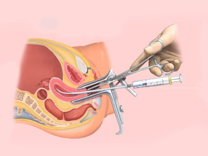 Mách bạn địa chỉ bơm tinh trùng ở Hà Nội