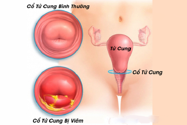 Mách mẹ cách điều trị hiệu quả viêm cổ tử cung sau sinh 