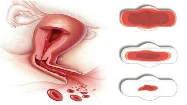 Mách mẹ cách điều trị hiệu quả viêm cổ tử cung sau sinh 