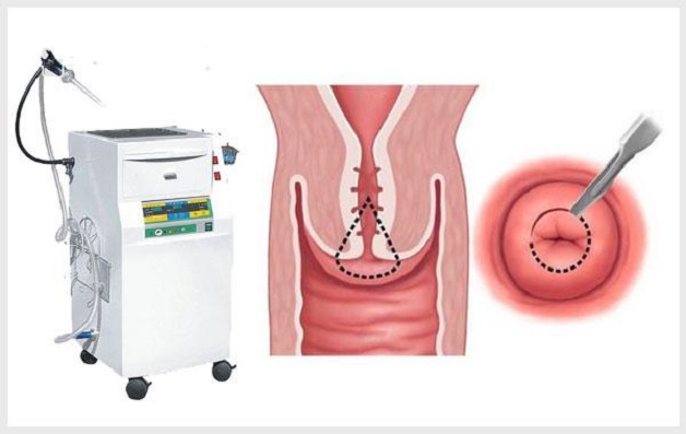 Mách mẹ cách điều trị hiệu quả viêm cổ tử cung sau sinh 