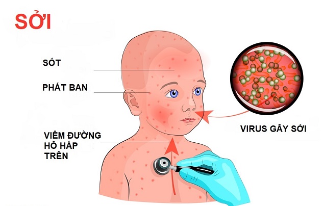 Mách mẹ cách phân biệt sốt phát ban và sởi 