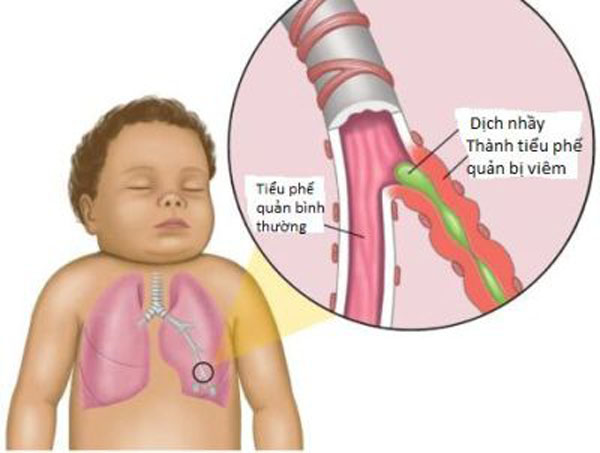 “Mách mẹ” cách phòng tránh biến chứng bệnh cảm lạnh