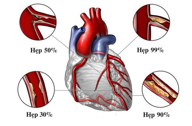 Mạch vành tim: Nguy cơ bệnh lý, cách điều trị và bảo vệ