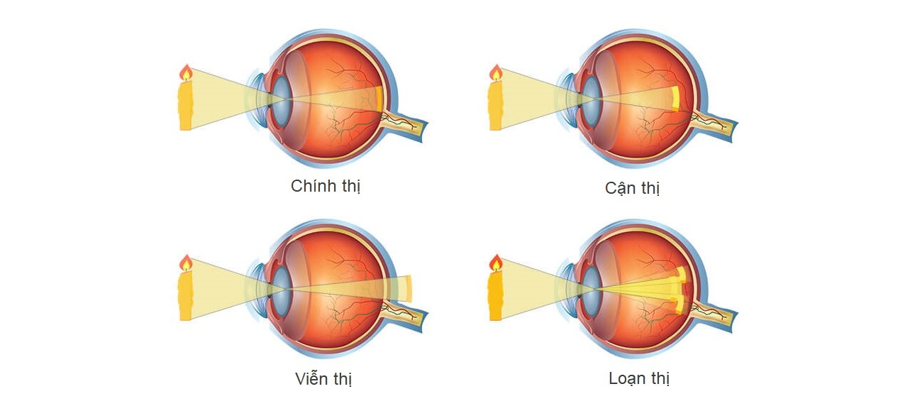 Mắt bị khúc xạ có nguy hiểm không?