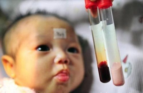 Mẹ bầu bị thiếu máu Thalassemia khi mang thai