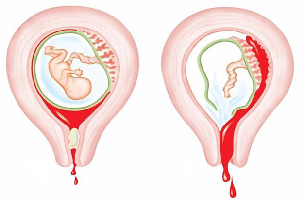 Mẹ bị bế sản dịch sau mổ đẻ có cần điều trị không?