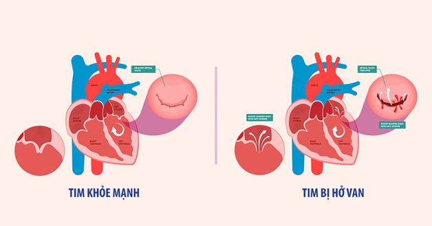 Mẹ hở van tim ba lá nhưng vẫn tự tin vượt cạn thành công