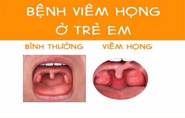 Mẹ nên làm gì khi bé bị viêm họng?