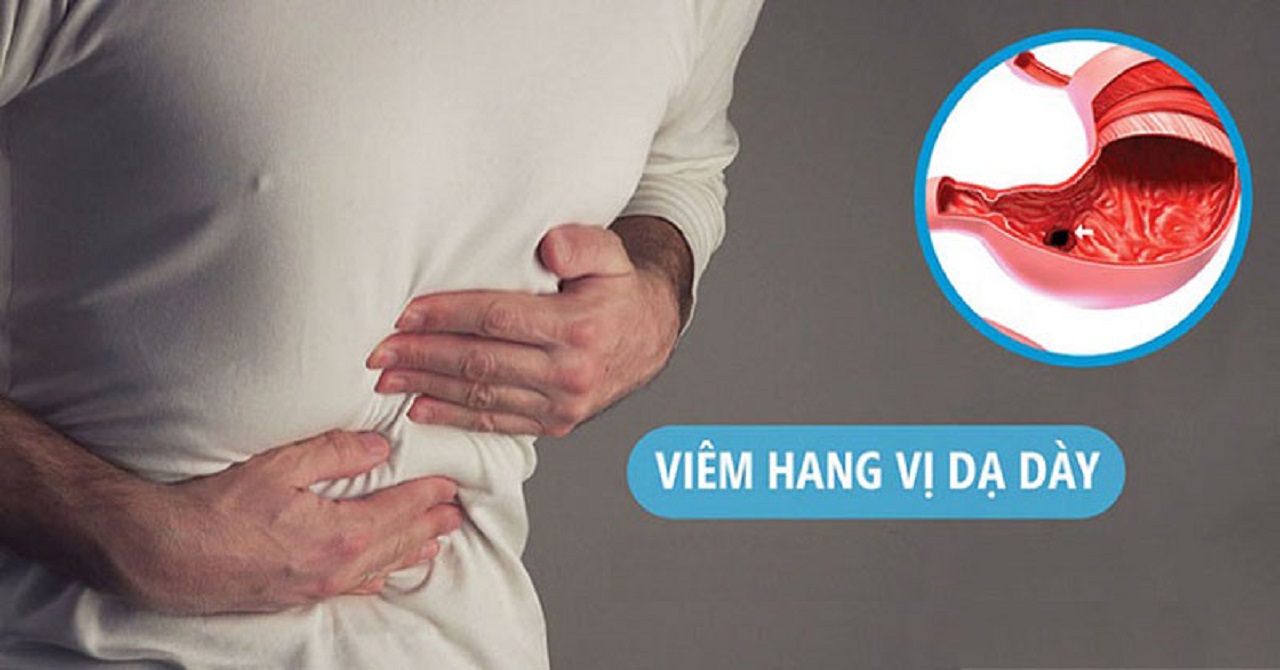 Mẹo chữa viêm hang vị dạ dày hiệu quả tại nhà