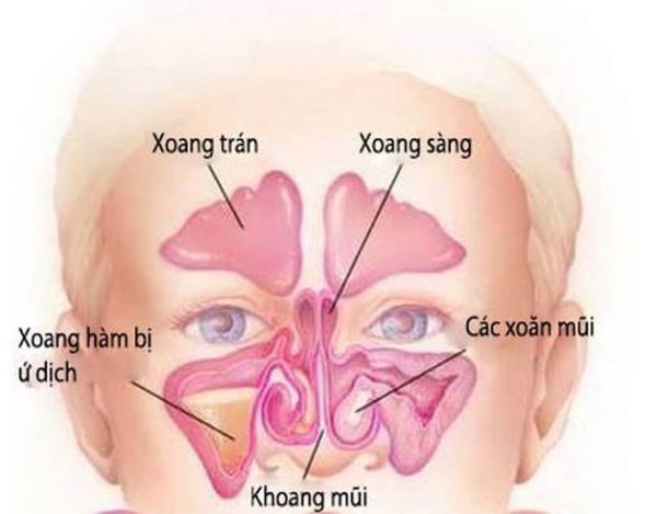 Mẹo vặt hàng ngày giúp cải thiện chứng viêm xoang mũi