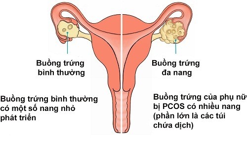 Mổ buồng trứng đa nang phẫu thuật mổ buồng trứng đa nang