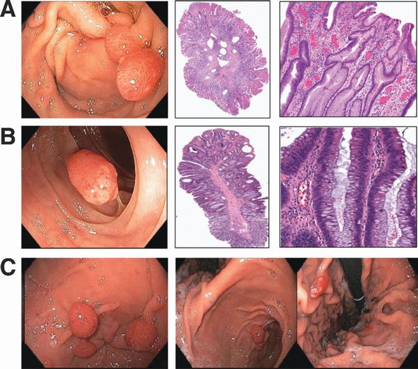 Mổ cắt polyp dạ dày ở đâu?