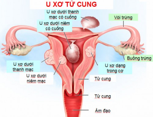 Mổ cắt tử cung có nguy hiểm không?