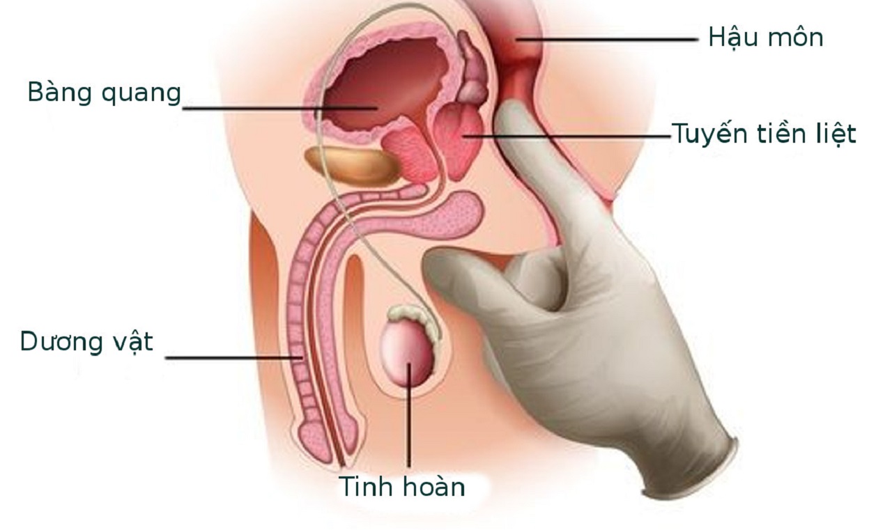 Mổ điều trị u xơ tiền liệt tuyến bằng laser – những điều cần biết