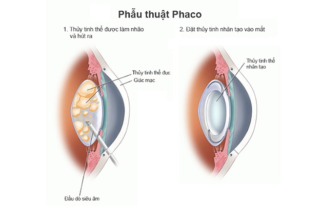 Mổ đục thủy tinh thể bằng phương pháp Phaco có ưu điểm gì?