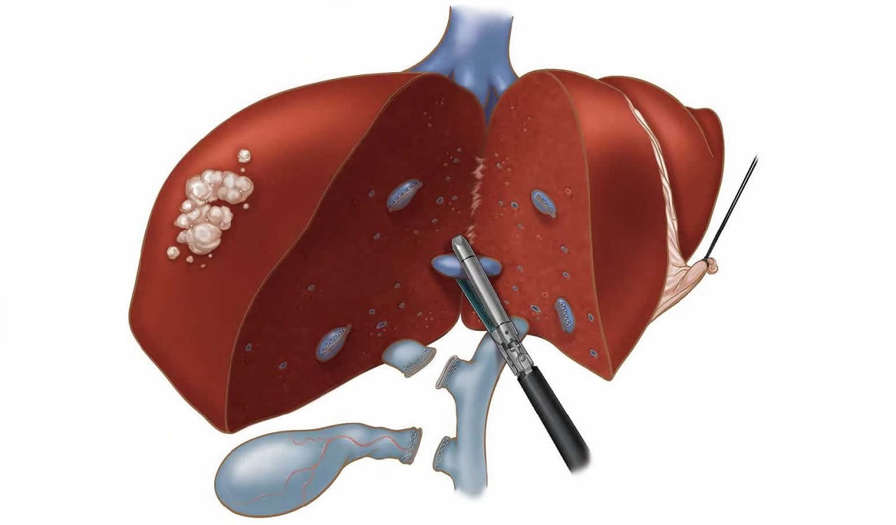 Mổ gan nội soi và những điều cần biết 