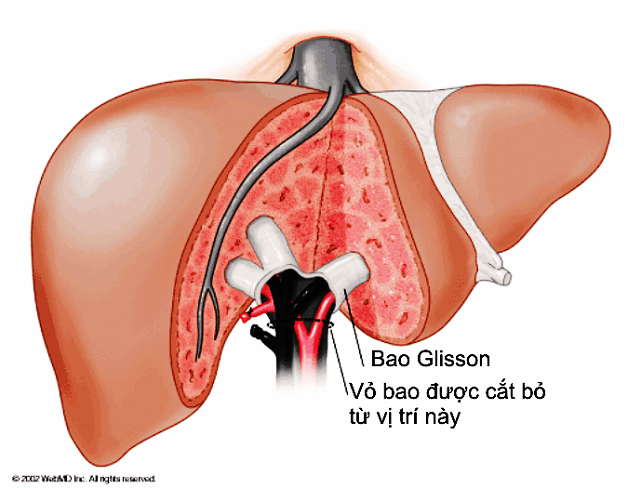 Mổ gan nội soi và những điều cần biết 