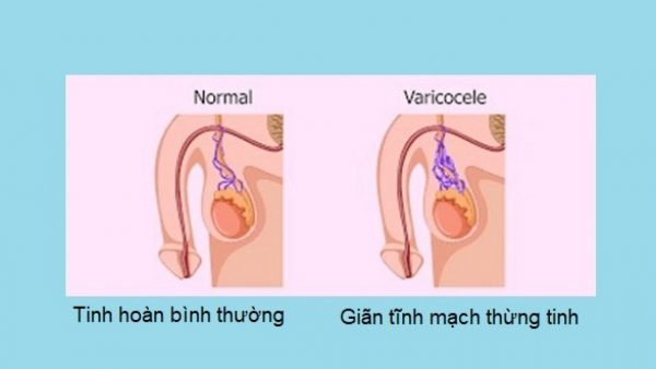 Mổ giãn tĩnh mạch thừng tinh bao lâu hồi phục?